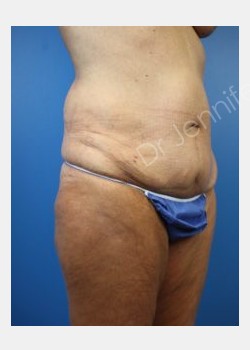 Before Image: abdominoplasty - front