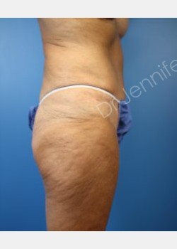 After Image: abdominoplasty - front