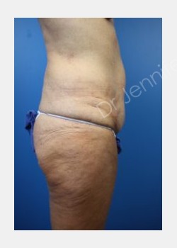 Before Image: abdominoplasty - front