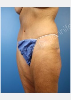 After Image: abdominoplasty - front