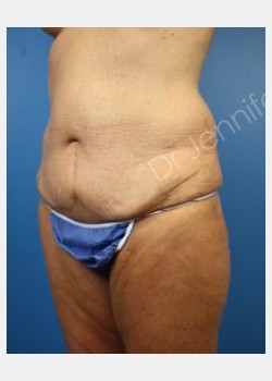 Before Image: abdominoplasty - front