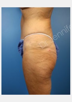 After Image: abdominoplasty - front