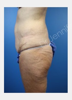 Before Image: abdominoplasty - front