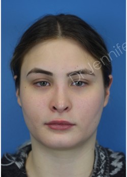 Rhinoplasty Revision after photo. Individual results may vary.