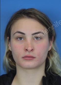 Rhinoplasty Revision before photo. Individual results may vary.