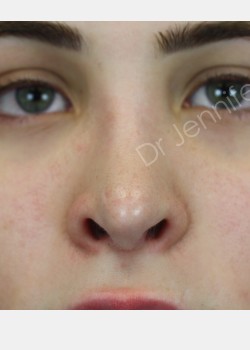 Rhinoplasty Revision after photo. Individual results may vary.