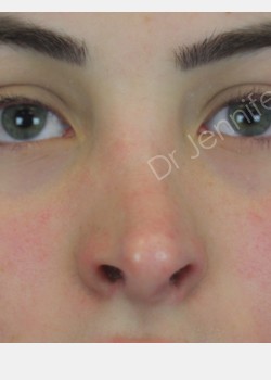 Rhinoplasty Revision before photo. Individual results may vary.