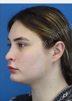 Rhinoplasty Revision after photo. Individual results may vary.