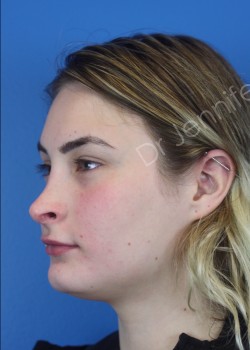 Rhinoplasty Revision before photo. Individual results may vary.