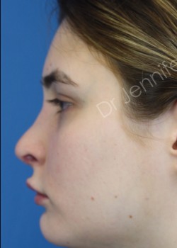 Rhinoplasty Revision after photo. Individual results may vary.