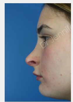 Rhinoplasty Revision before photo. Individual results may vary.