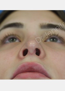 Rhinoplasty Revision after photo. Individual results may vary.
