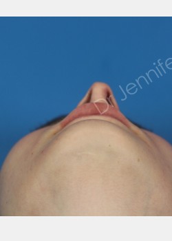Rhinoplasty Revision before photo. Individual results may vary.
