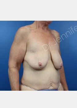 Breast Mastopexy before photo. Individual results may vary.