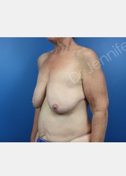 Breast Mastopexy before photo. Individual results may vary.