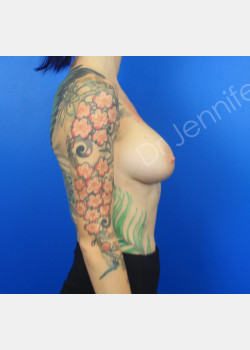 After Image: Breast Augmentation - front