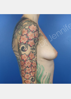 Before Image: Breast Augmentation - front