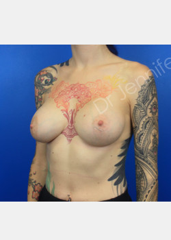 After Image: Breast Augmentation - front
