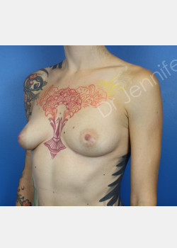 Before Image: Breast Augmentation - front