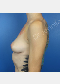 Before Image: Breast Augmentation - front