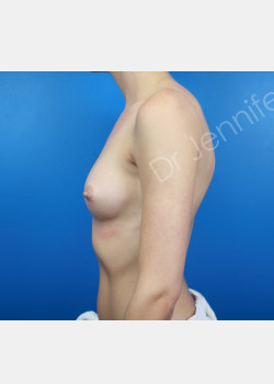 Before Image: Breast Augmentation - front