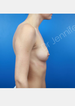 Before Image: Breast Augmentation - front