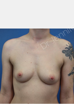 Before Image: Breast Enhancement with Fat Transfer - front