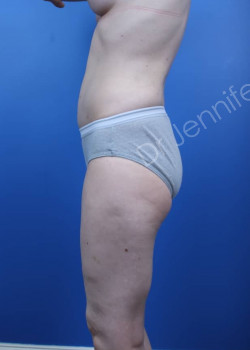 After Image: Breast Enhancement with Fat Transfer - front