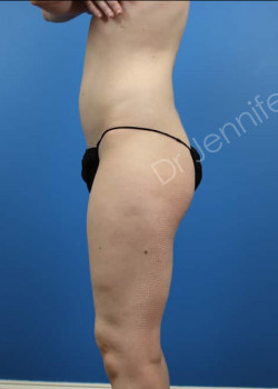 Before Image: Breast Enhancement with Fat Transfer - front