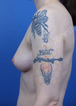 After Image: Breast Enhancement with Fat Transfer - front