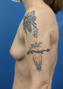 Before Image: Breast Enhancement with Fat Transfer - front