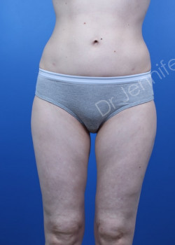 After Image: Breast Enhancement with Fat Transfer - front
