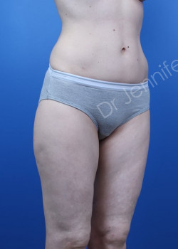 After Image: Breast Enhancement with Fat Transfer - front