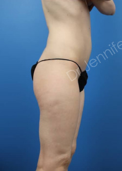 Before Image: Breast Enhancement with Fat Transfer - front