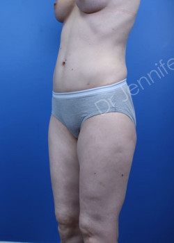 After Image: Breast Enhancement with Fat Transfer - front
