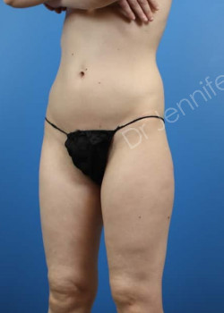 Before Image: Breast Enhancement with Fat Transfer - front