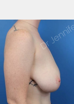 Before Image: Breast Reduction - front