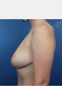 After Image: Breast Reduction - front