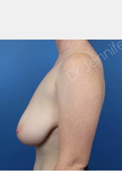 Before Image: Breast Reduction - front