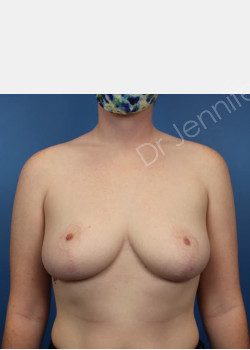After Image: Breast Reduction - front