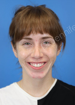 Rhinoplasty after photo. Individual results may vary.
