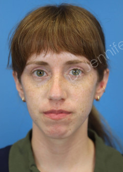 Rhinoplasty before photo. Individual results may vary.