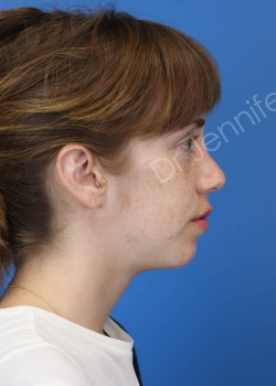 Rhinoplasty after photo. Individual results may vary.