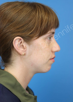 Rhinoplasty before photo. Individual results may vary.
