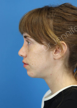 Rhinoplasty after photo. Individual results may vary.