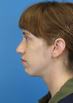 Rhinoplasty before photo. Individual results may vary.