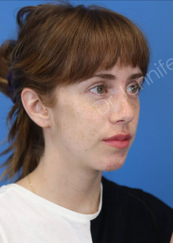 Rhinoplasty after photo. Individual results may vary.