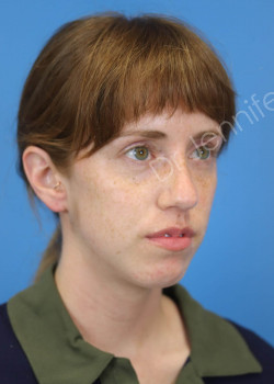 Rhinoplasty before photo. Individual results may vary.