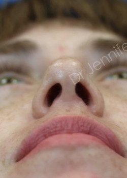Rhinoplasty after photo. Individual results may vary.