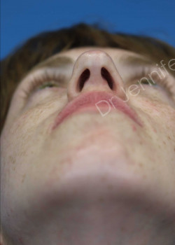 Rhinoplasty before photo. Individual results may vary.